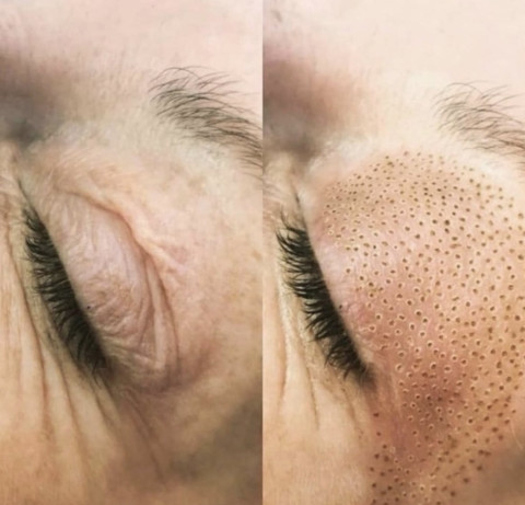 Plasma Lift Boven oogleden
